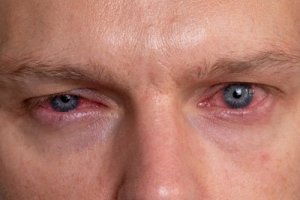 Herpes Keratitis, What Is It?