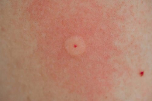 A person with a sting.
