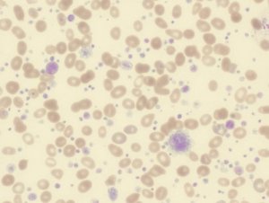Thrombocytosis: Symptoms, Causes, and Treatment