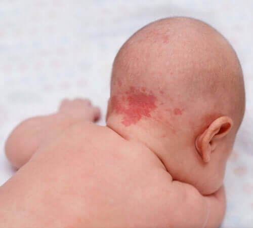 Birthmarks and Moles: Why Do They Appear? — Step To Health