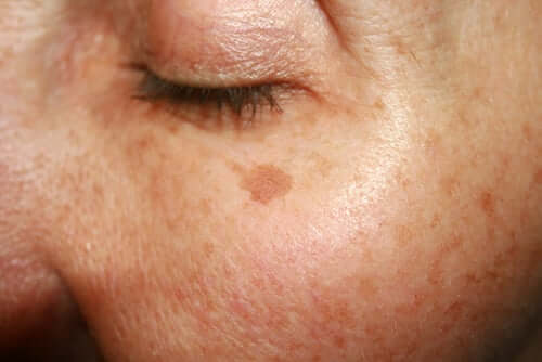 A person with an age spot.