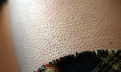 A person with goosebumps.