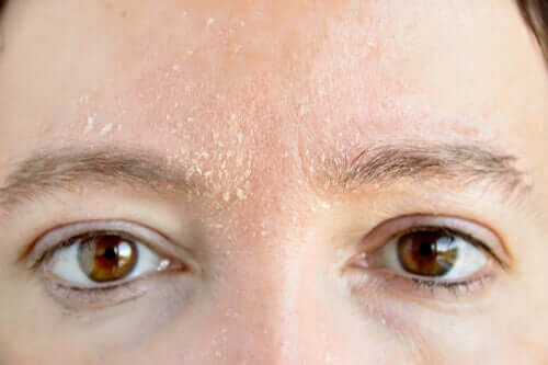 A person with flaky skin.