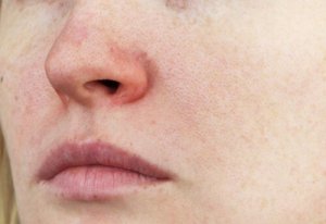 Couperose: Characteristics and Treatments