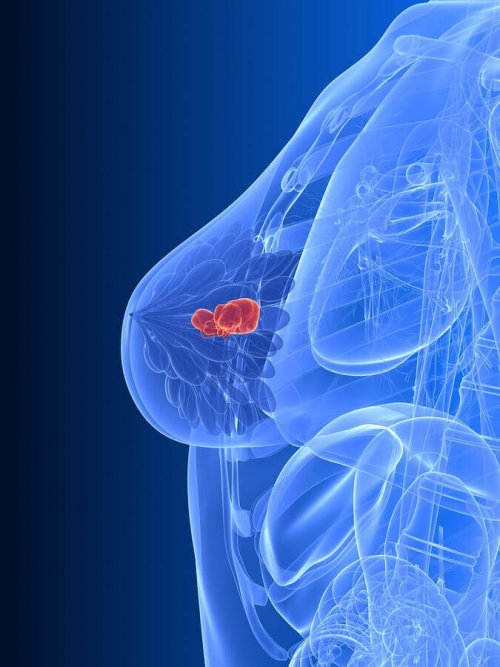 An illustration of breast cancer.