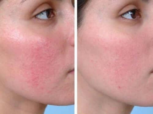 Before and after shot of a person with Rosacea