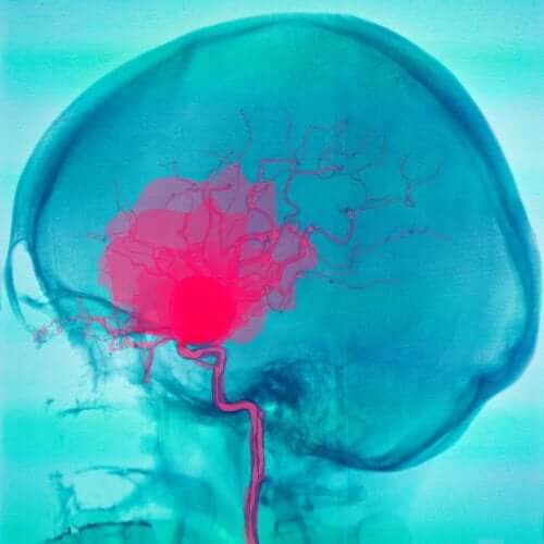 Subarachnoid and Subdural Hemorrhages