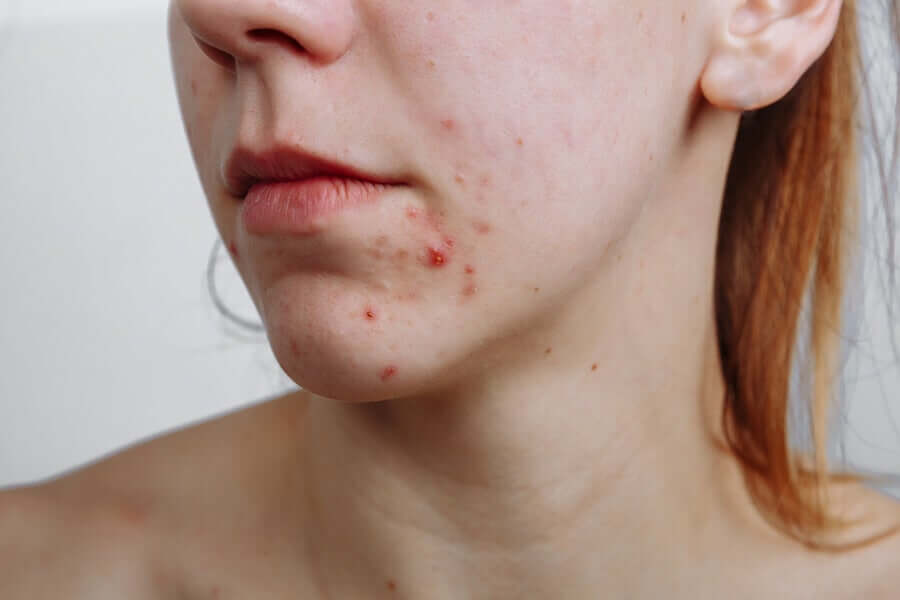 There are lots of different acne treatments because acne has lots of different causes.