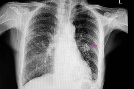 What Exactly Is a Lung Nodule?