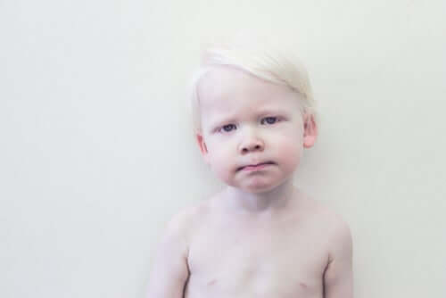 Ett barn med albinism.