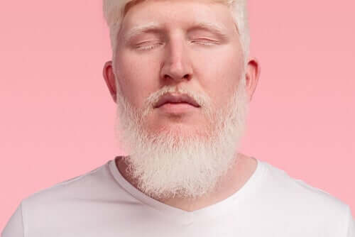 En man med albinism.