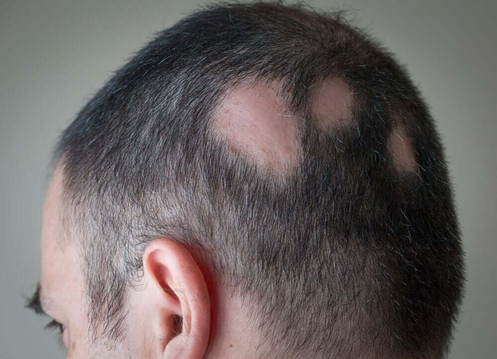 A man with alopecia.