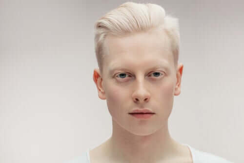 Learn All about Albinism