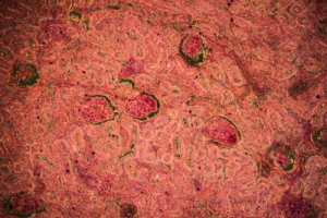 Renal Tuberculosis: Diagnosis and Treatment