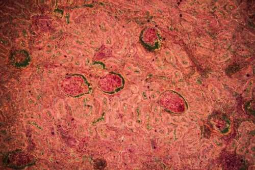 Renal Tuberculosis: Diagnosis and Treatment