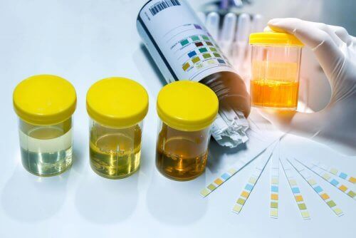 Urinalysis test strips.