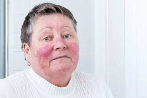 Causes and Symptoms of Rosacea