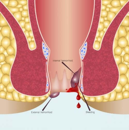 Anoscopy - An Overview of the Procedure