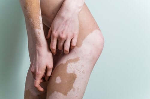 A person with vitiligo.