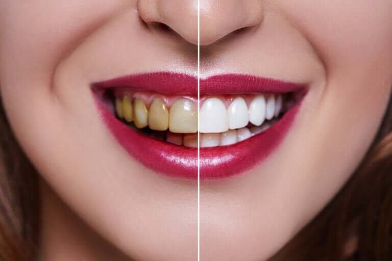 Kvinnas leende med hälften gula och hälften vita tänder