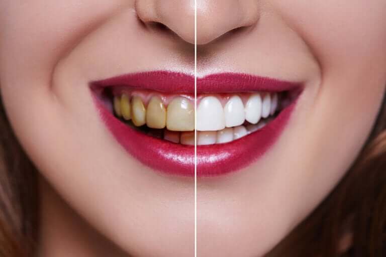 Woman with stained and whitened teeth.