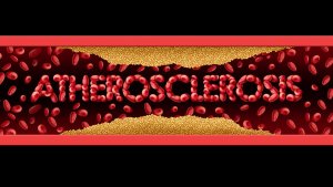 Atherosclerosis: Symptoms and Treatment