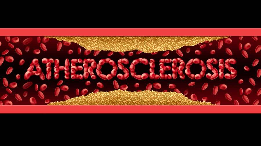 Atherosclerosis: Symptoms and Treatment