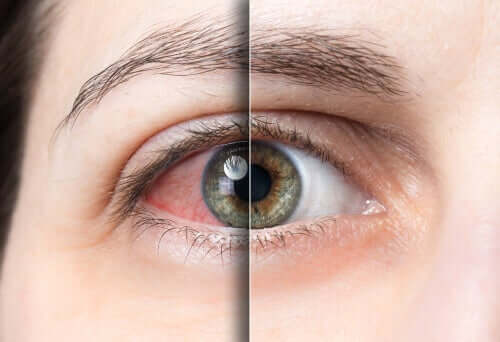 A patient with pink eye.