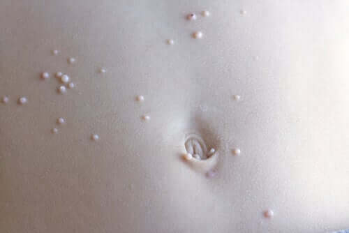 Pimples on the skin.
