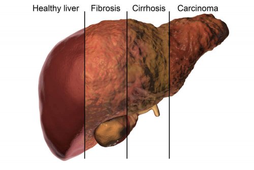 Liver damage due to alcohol and antibiotics.