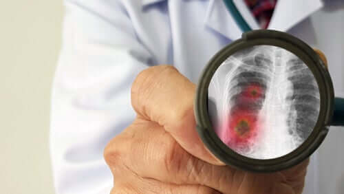 Coronavirus can lead to pneumonia and acute respiratory syndrome.