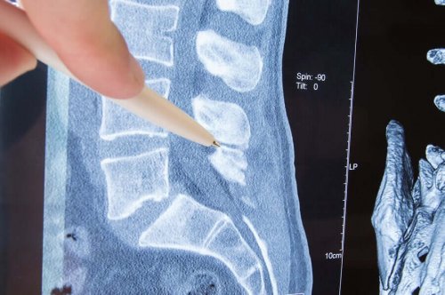 Radiculopathy: Causes, Symptoms, and Treatment