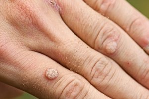 Types of Warts and Treatments