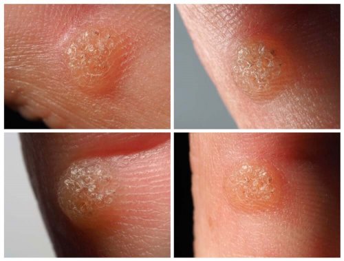 Warts on the fingers.