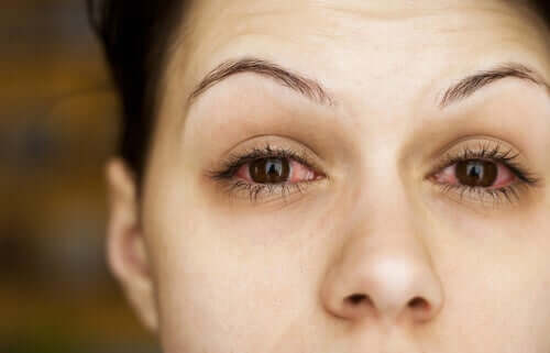 Woman with red, dry eyes.