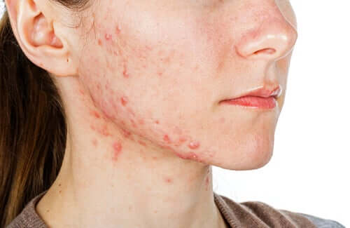 A young woman with acne.