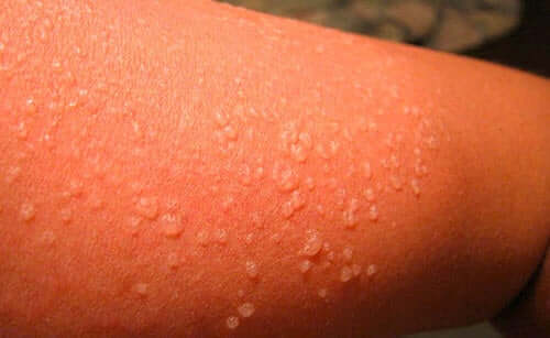 Does coronavirus cause blisters?