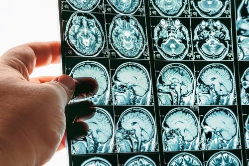 Cerebral Herniation