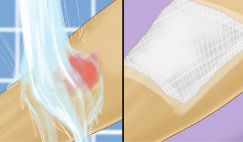 A person applying cold water to a burn.