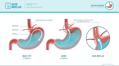 Graphic showing gastroesophageal reflux.