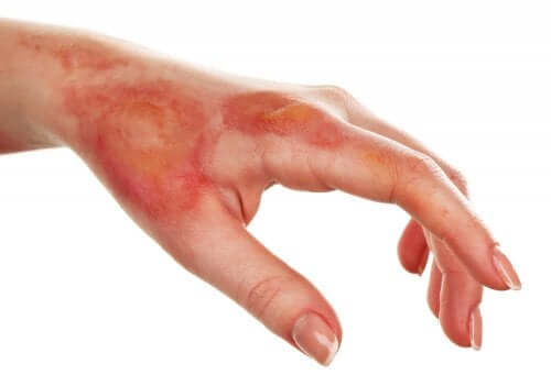 A burnt hand.