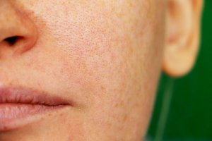 Three Natural Remedies for Melasma