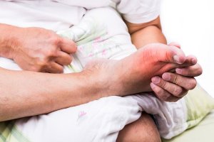 Gout Diet: Recommendations and Prohibitions