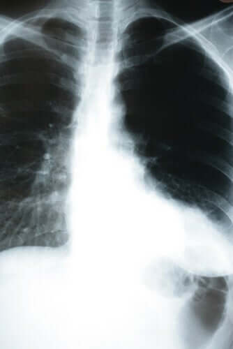 How Pneumonia Affects the Body