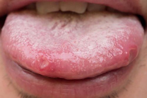 Remedies for Oral Candidiasis: Natural Alternatives