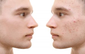 How to Use Turmeric to Treat Acne