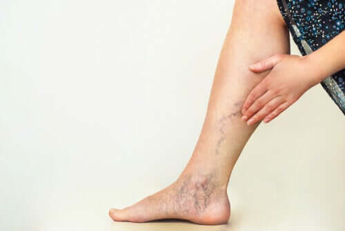 Varicose veins in women.
