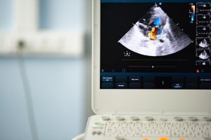 Bicuspid Aortic Valve: Diagnosis and Treatment