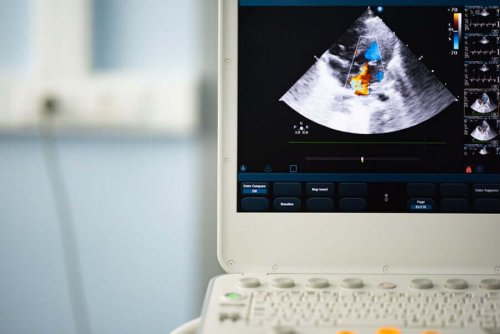 Bicuspid Aortic Valve: Diagnosis and Treatment