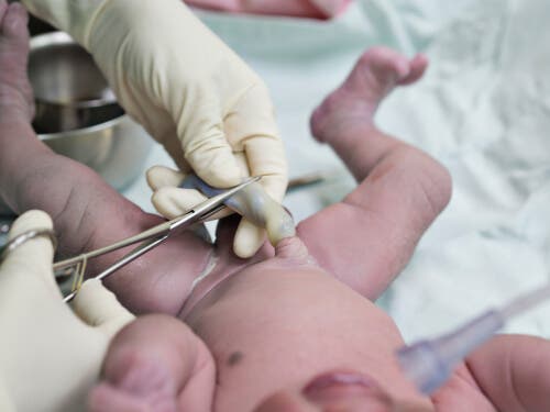 A doctor cutting the umbilical cord, which will later be the baby's belly button